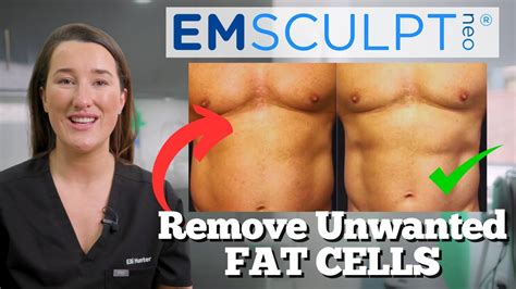 neo sculpting oakdale|Emsculpt NEO Specialist .